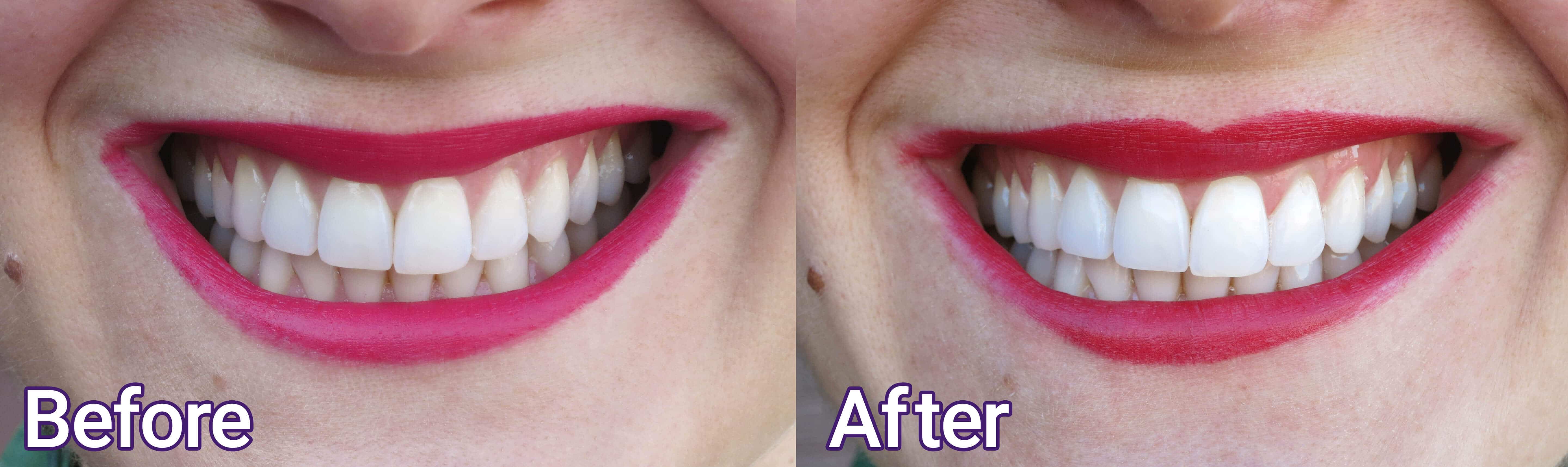 Smile Brilliant Teeth Whitening Before and After by Modnitsa Styling